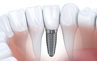 Animation of implant dental crown